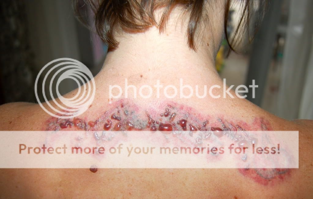 laser tattoo removal gone wrong natural tattoo removal laser is