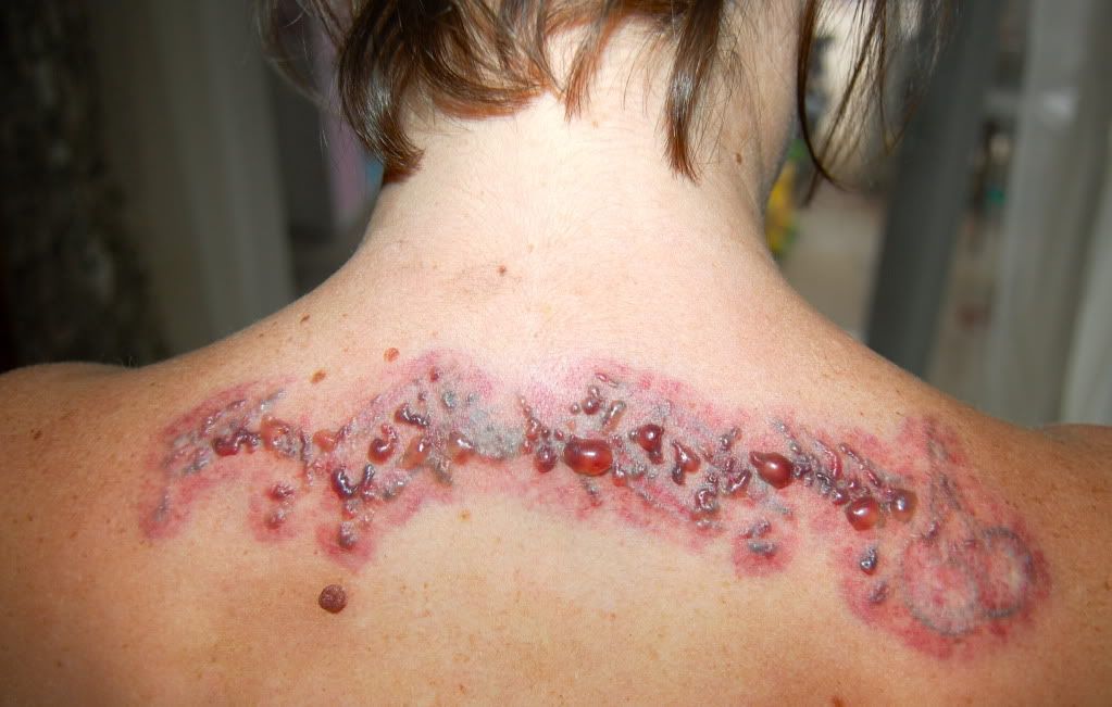 laser tattoo removal gone wrong natural tattoo removal laser is